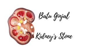 Read more about the article Kidney stones, occur unconsciously