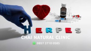 Read more about the article Ozone Therapy for Herpes (HSV-1 & HSV-2) : Latest Unexpected Clinical Reviews